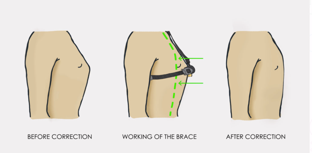 Carinatum Pectus Carinatum (Pigeon Chest) Brace - Back, Chest & Torso Supports - Orthopaedic Supports - Fu Kang Healthcare Shop Online Carinatum Pectus Carinatum (Pigeon Chest) Brace - Back, Chest & Torso Supports - Orthopaedic Supports - Fu Kang Healthcare Shop Online